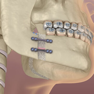 Orthognathic Surgery