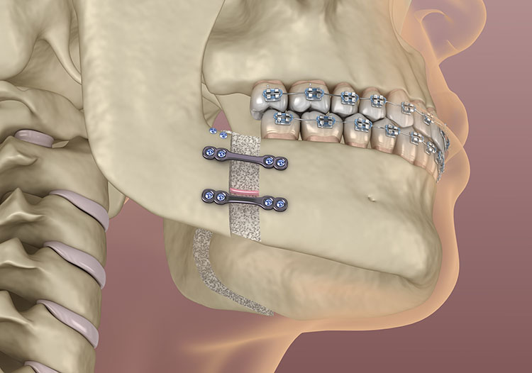 Orthognathic Surgery